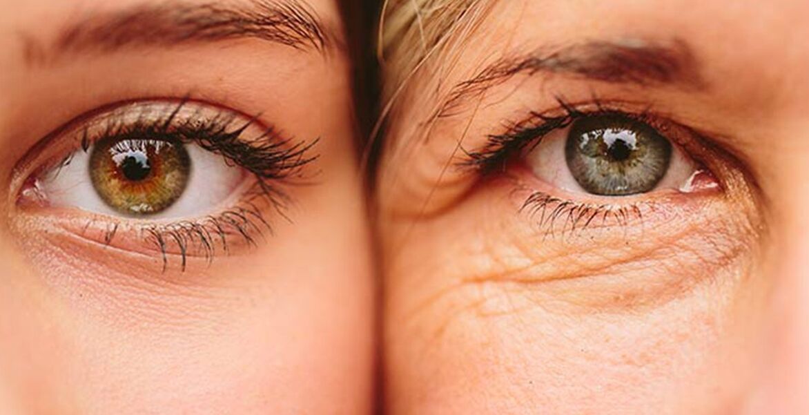 Signos externos de envellecemento da pel ao redor dos ollos en dúas mulleres de diferentes idades