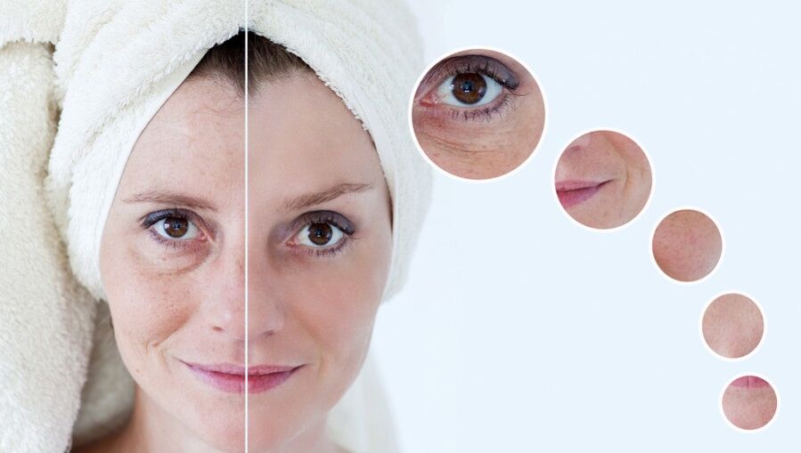 antes e despois do rexuvenecemento da pel con plasma