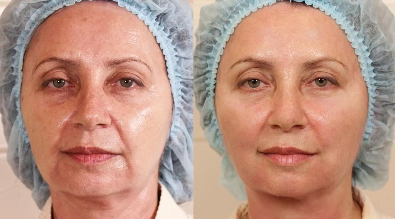 Fotos de antes e despois de lifting facial