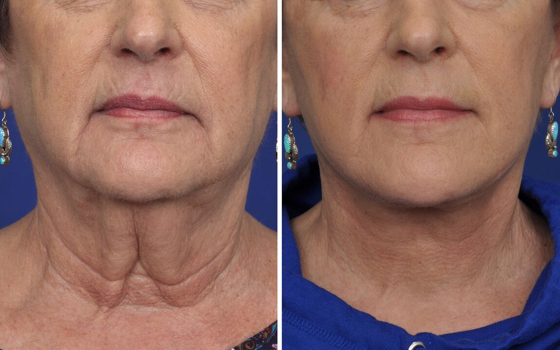 antes e despois dos procedementos de rexuvenecemento da pel