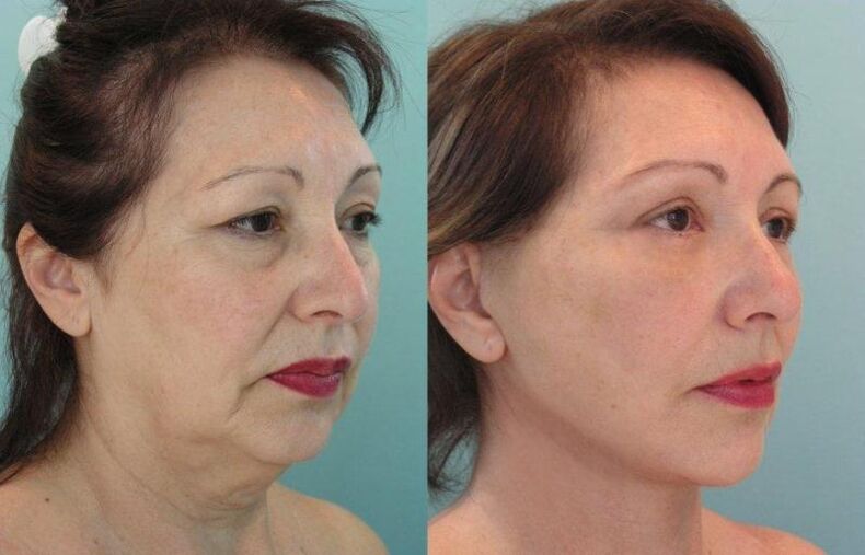 O resultado dun rexuvenecemento da pel facial tensado con fíos