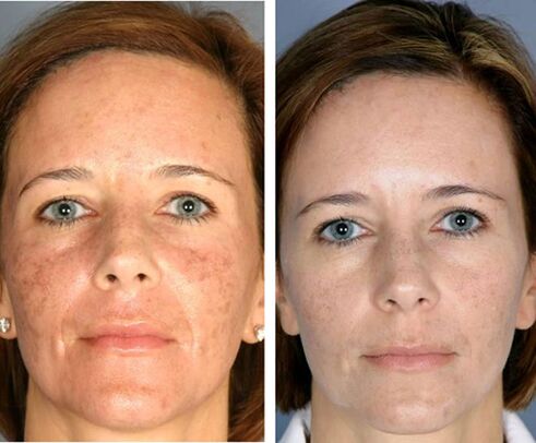 Antes e despois da termólise facial fraccionada