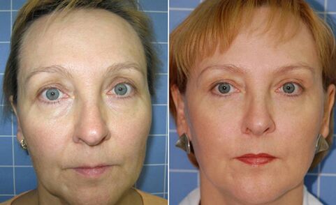 Antes e despois do rexuvenecemento facial fraccionado con láser