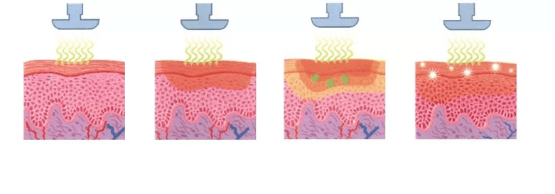 Como funciona un dispositivo de rexuvenecemento na pel